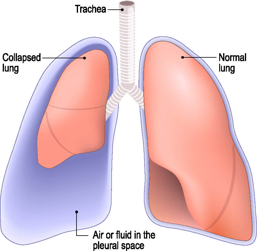 Nursing Skill Check: Replacing a Closed Chest Drainage 