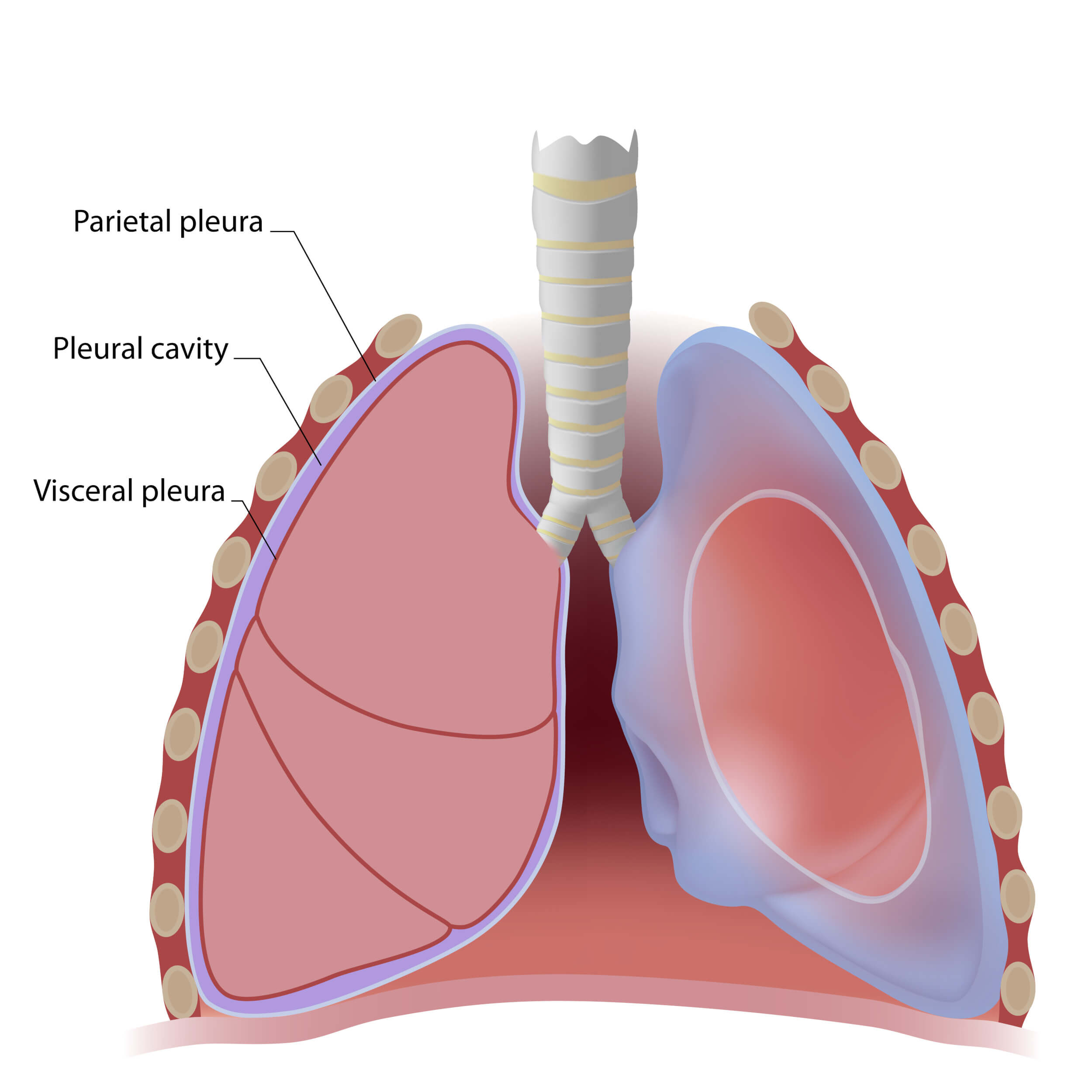 serosanguinous drainage from chest tube