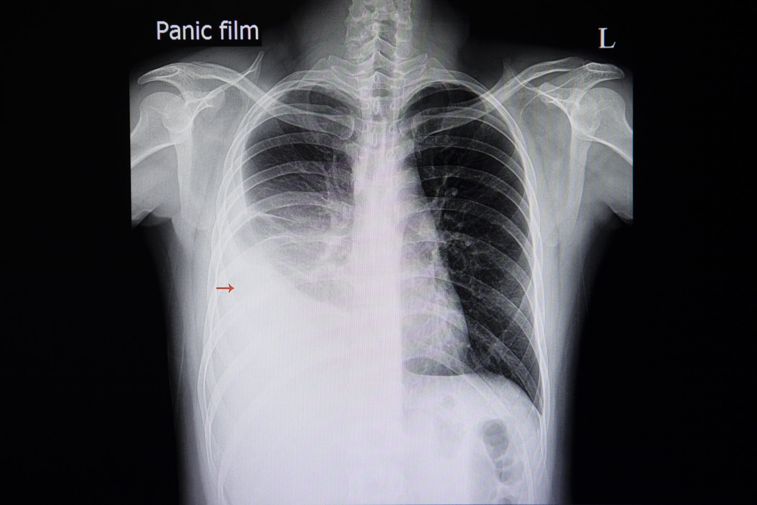 1180. Complications of chest tube placement (8) // Management of subacute  PTX // Amount of blood needed to blunt costophrenic angle in upright CXR //  If hemothorax, what size chest tube? // Indications for OR thoracotomy –  emupdates