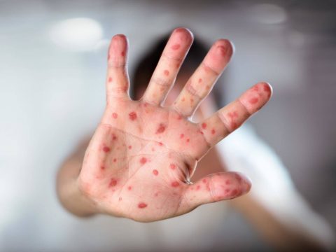 Measles: The Forgotten Virus is Making a Comeback