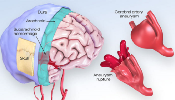     Cerebral Aneurysm: Heart.org 2021