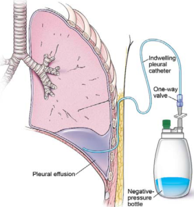 Chest Tubes Nursing Care CEU - Nursing CE Central