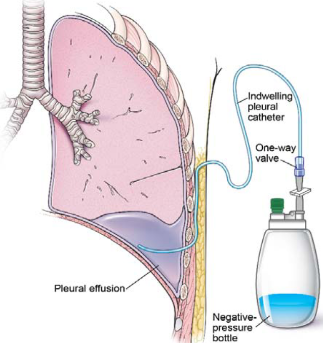 chest tubes course image