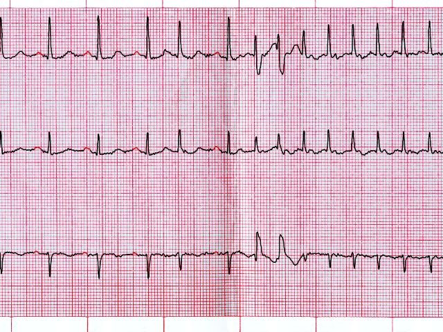 atrial fibrillation on EKG