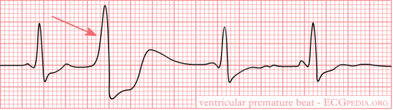 Telemetry and EKG Basics: Rhythm Recognition