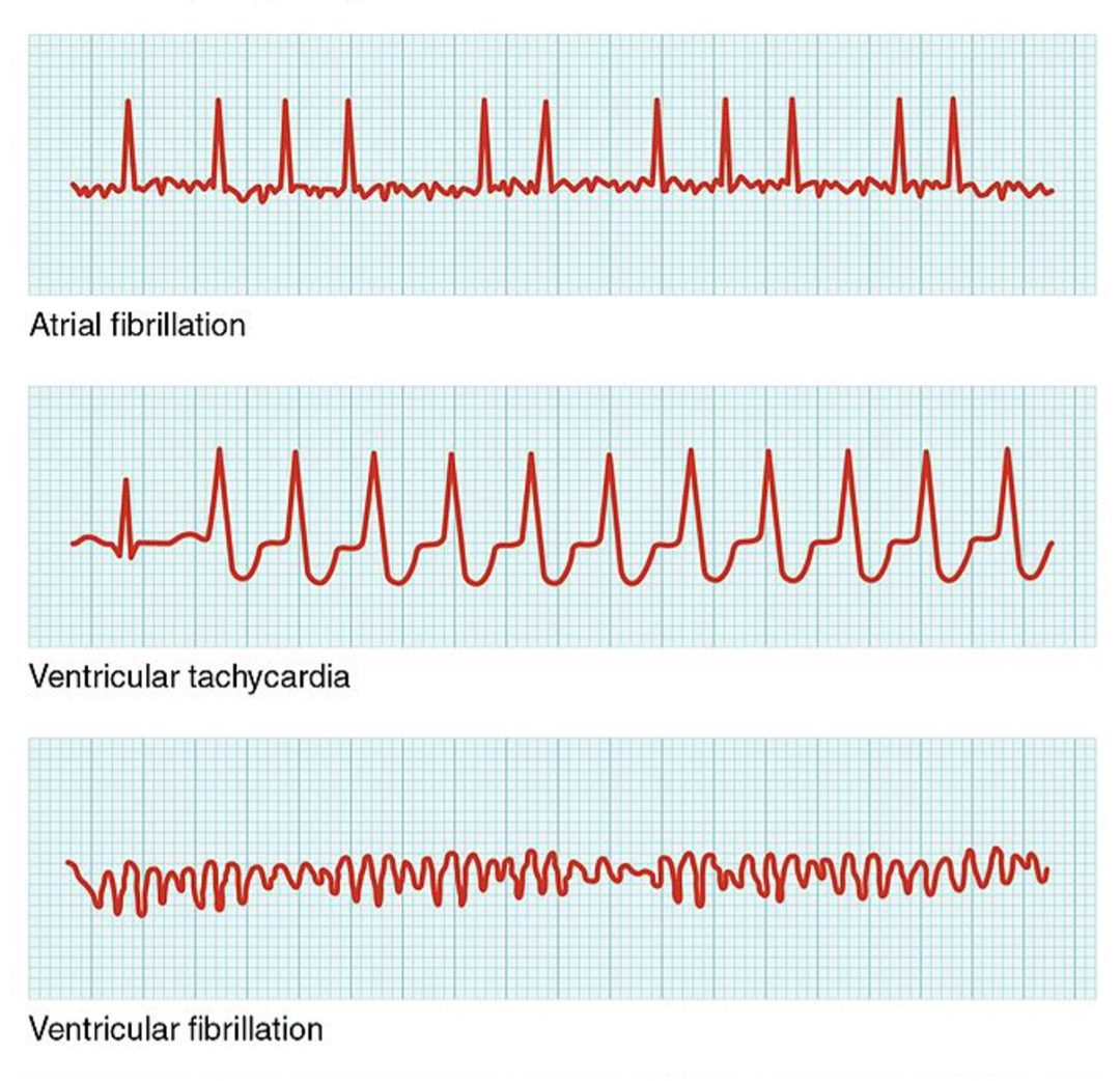 Anti-Arrhythmics - Nursing CE Central