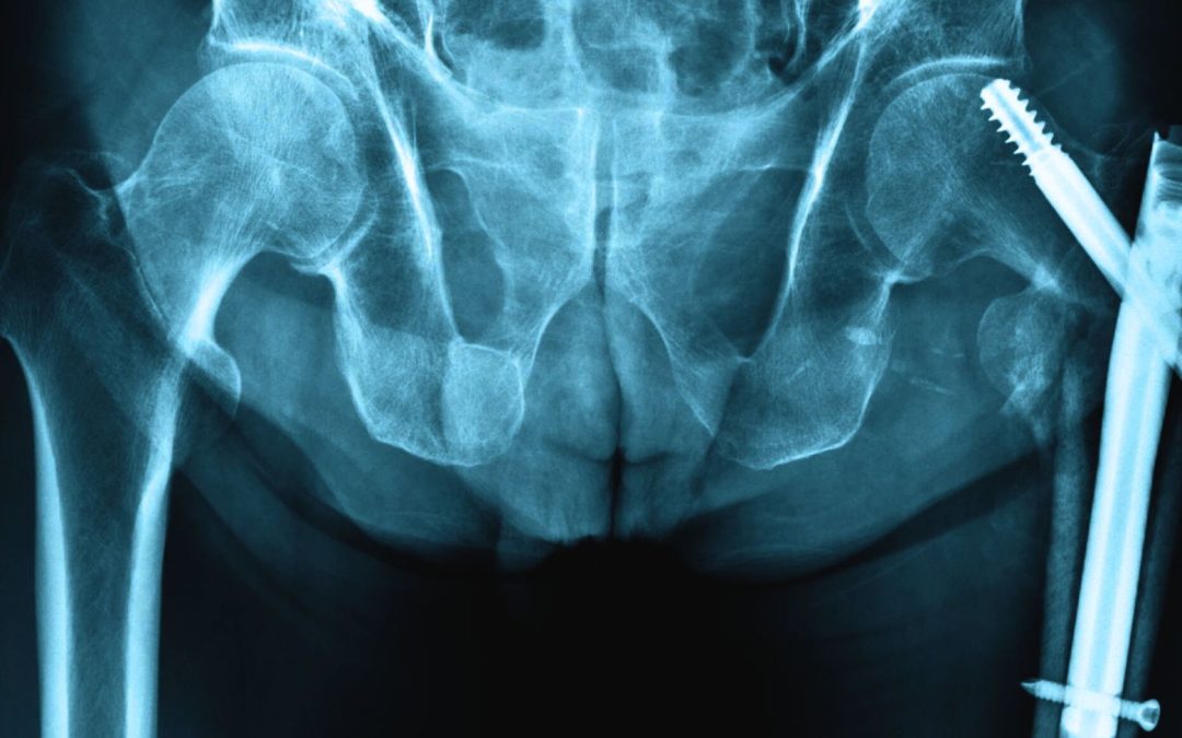 Long-Term Care Nurse’s Guide to Hip Fractures