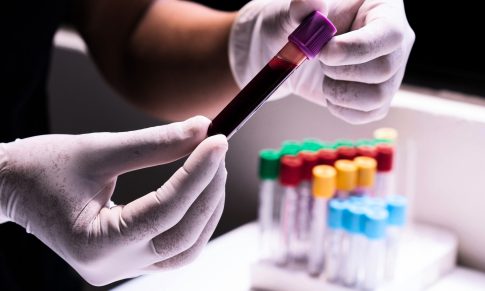 Understanding Lupus Nephritis