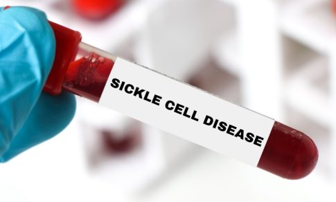 Supporting the Patient in Sickle Cell Crisis