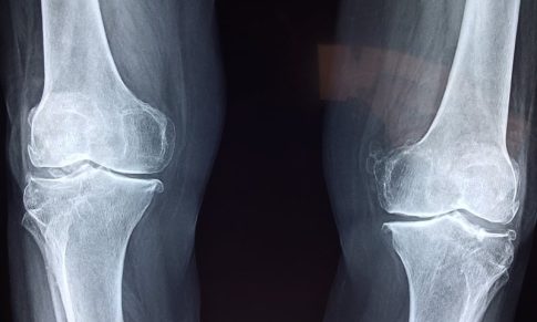 External Fixator Care and Considerations