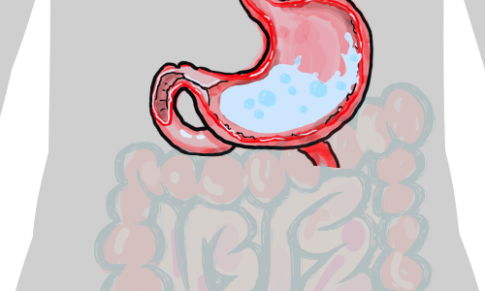 Gastric Sleeve Considerations
