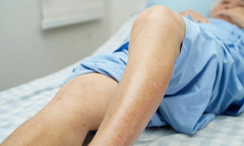 Peripheral Artery Disease